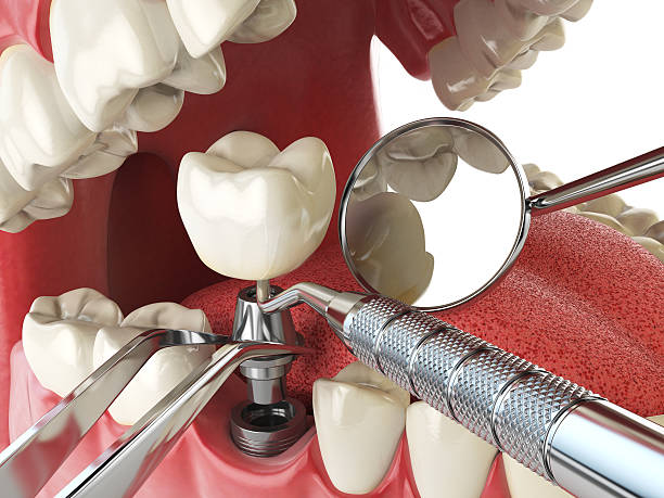 Best Emergency Tooth Extraction in Arbutus, MD